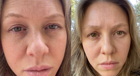 Can Red Light Therapy for Under Eye Bags Help? The Science Explained