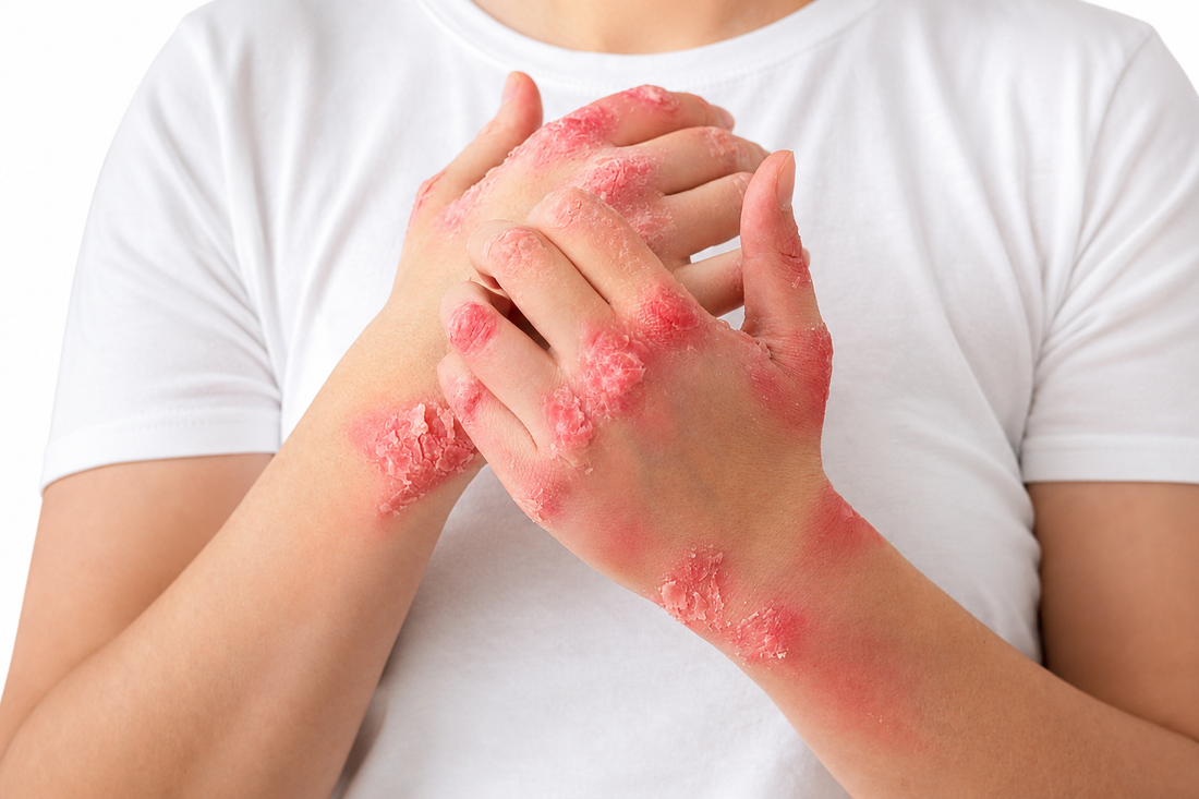 Red Light Therapy and Psoriasis: What the Research Says