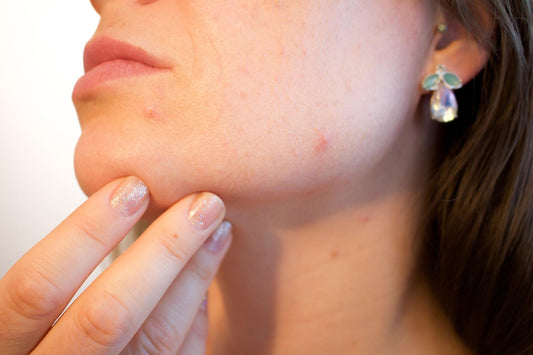 Does Red Light for Acne Really Work? Here’s What Science Says