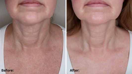 How Red Light Therapy Benefits the Neck: Skin, Muscle & More
