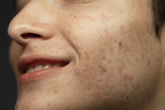 What the Research Actually Shows about Vitamin C for Sun Spots